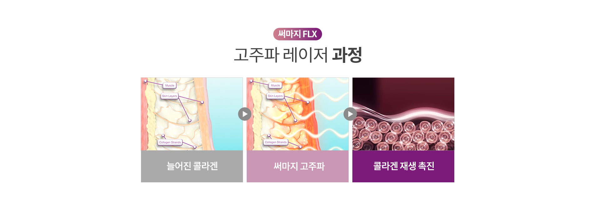 써마지FLX 고주파 레이저 과정