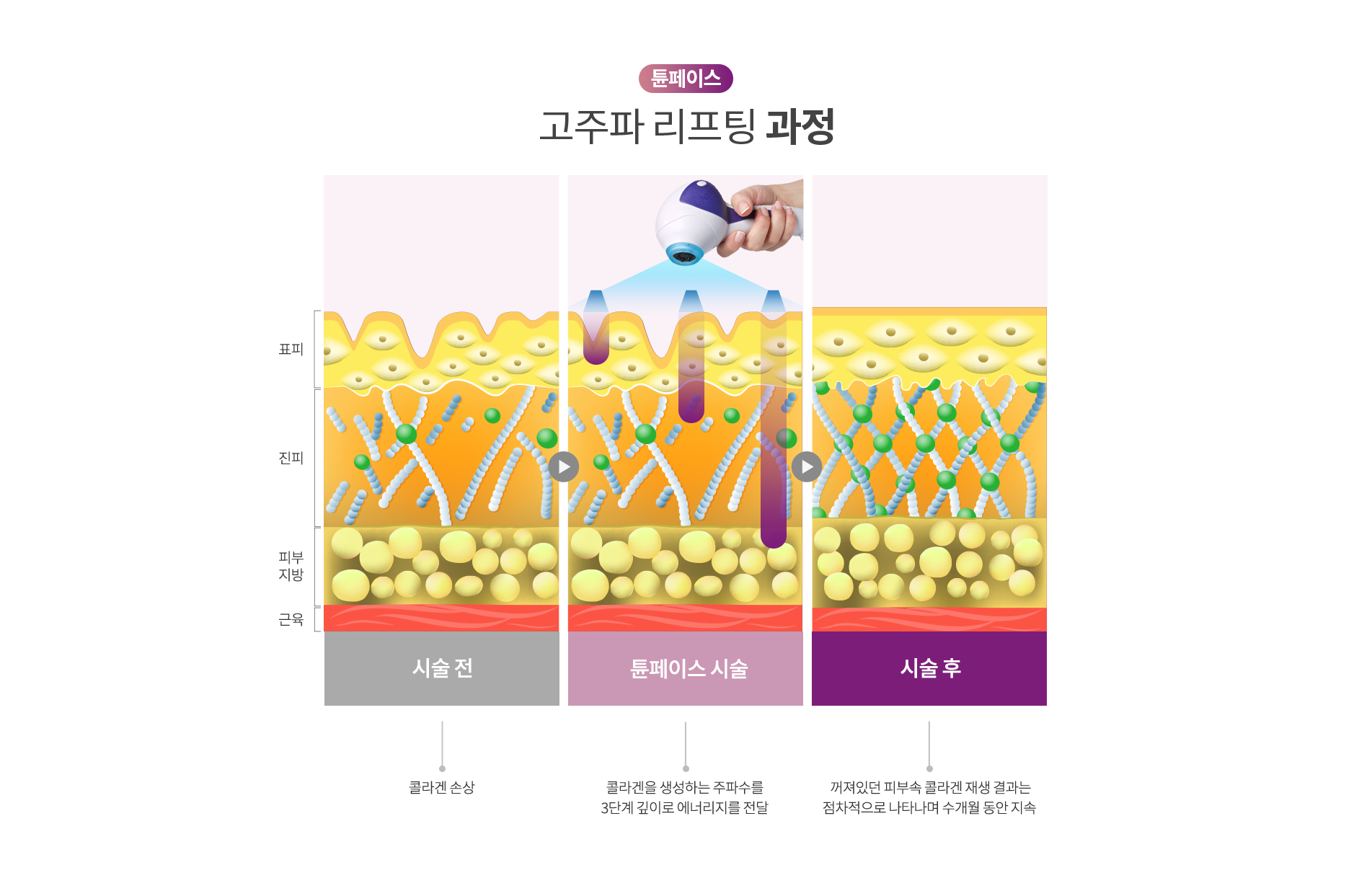 튠페이스 고주파 리프팅 과정