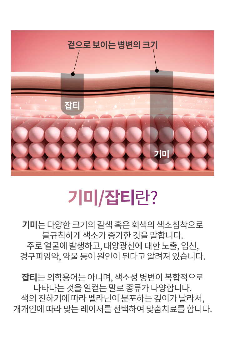 기미/잡티란?