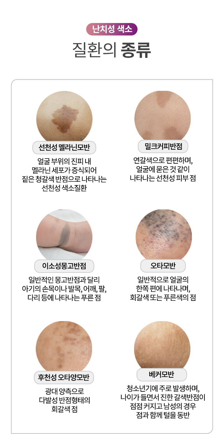 난치성 색소 질환의 종류