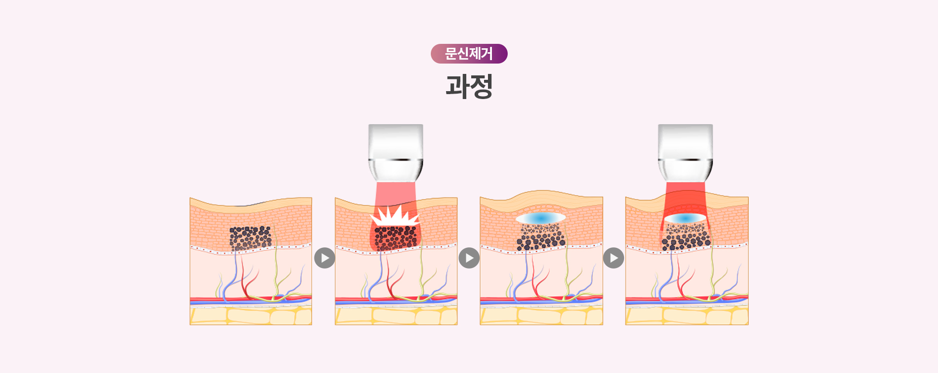 문신제거 과정