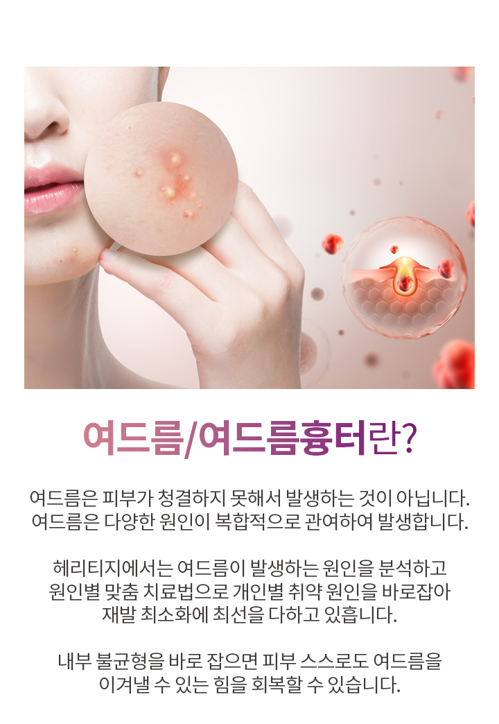 여드름/여드름 흉터란?