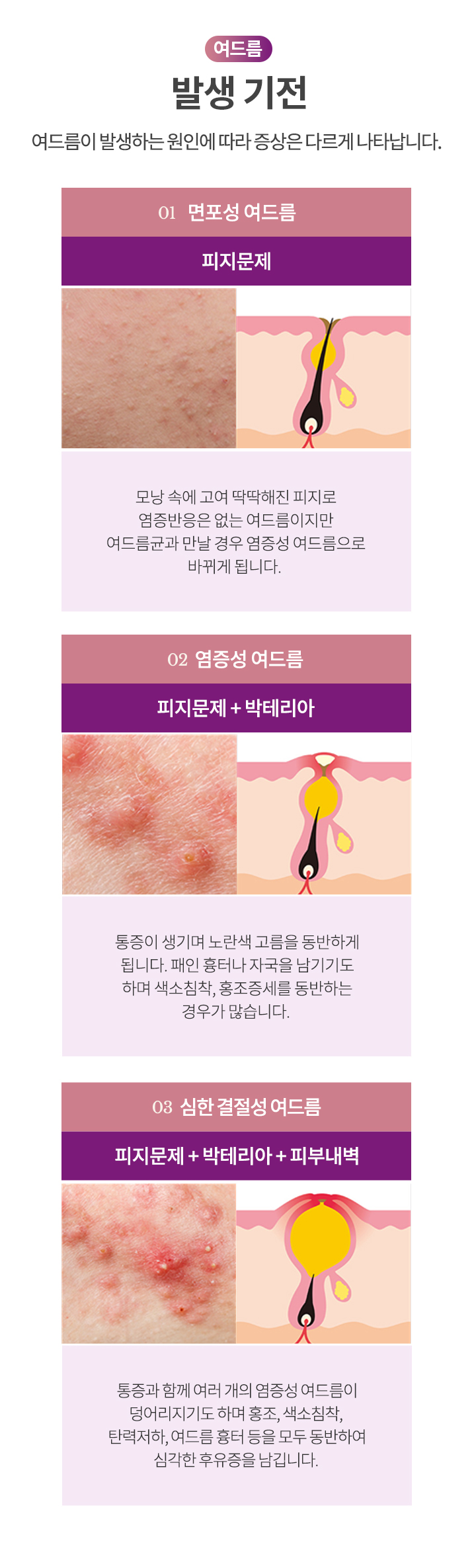 여드름 발생 기전