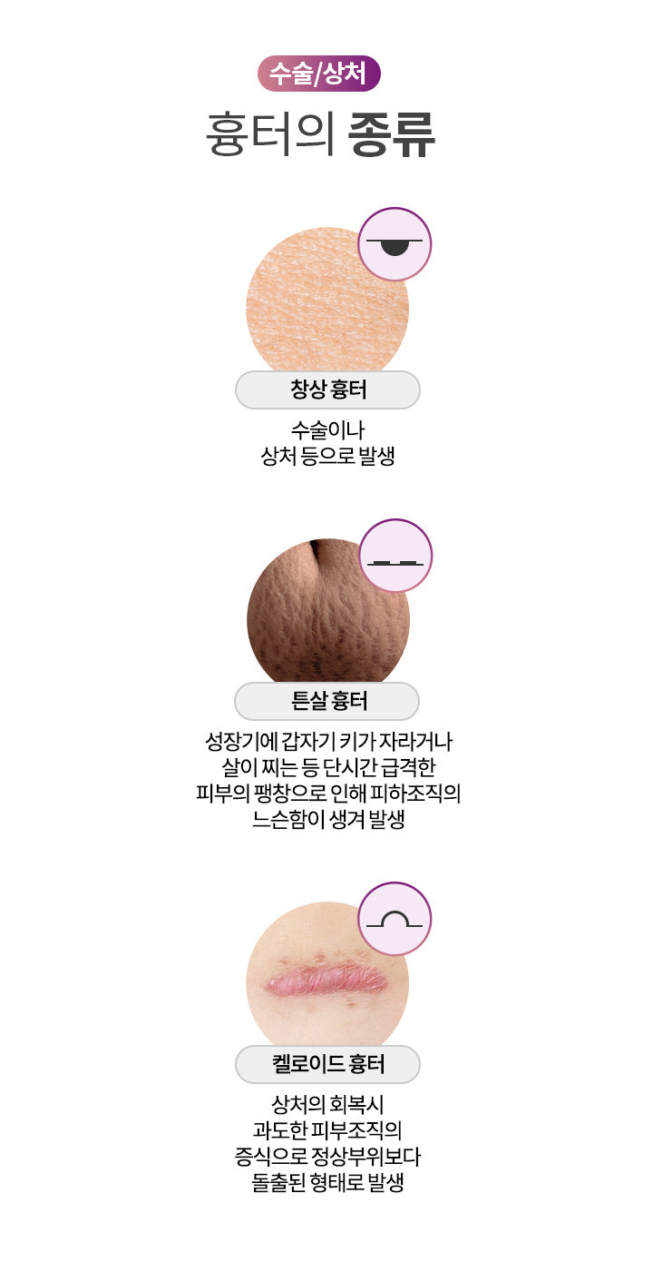 수술/상처 흉터의 종류