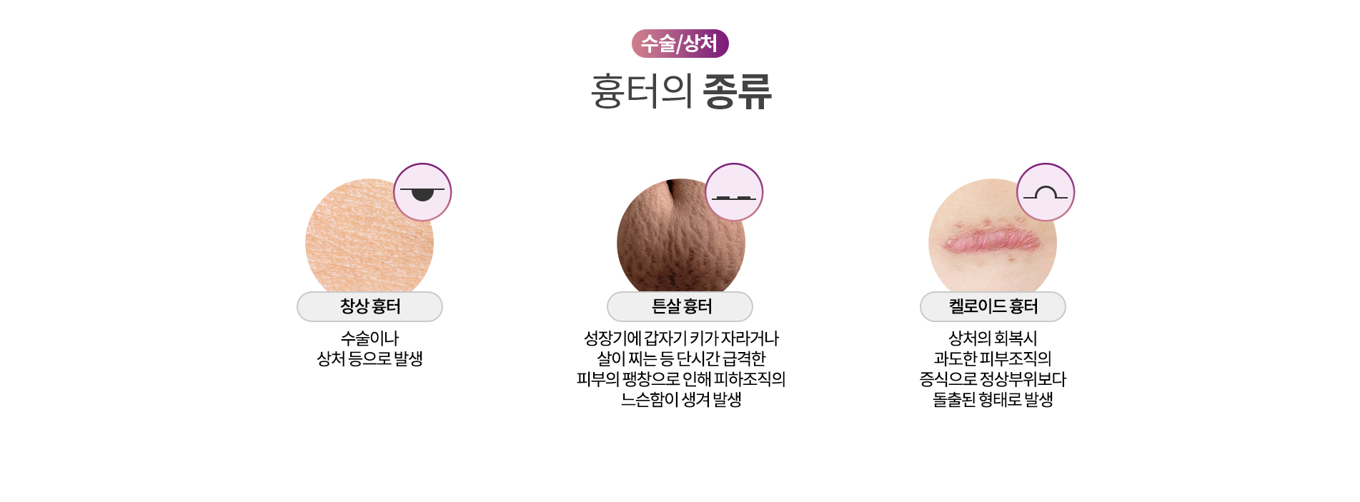 수술/상처 흉터의 종류