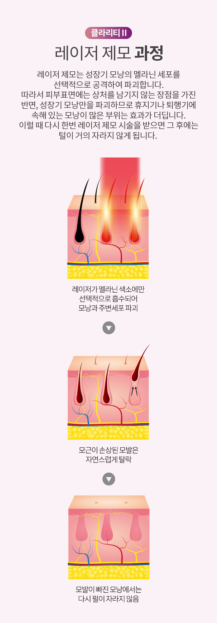 클라리티2 레이저 제모 과정