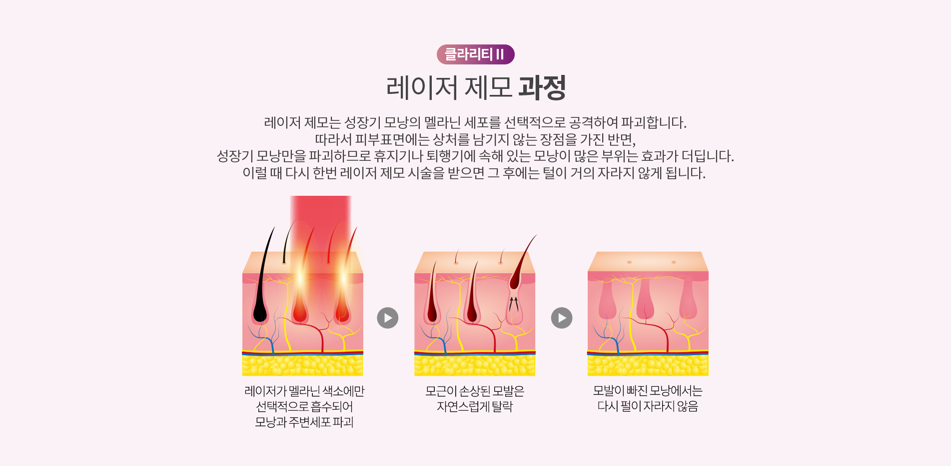 클라리티2 레이저 제모 과정