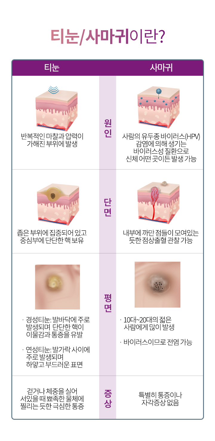 티눈/사마귀란?