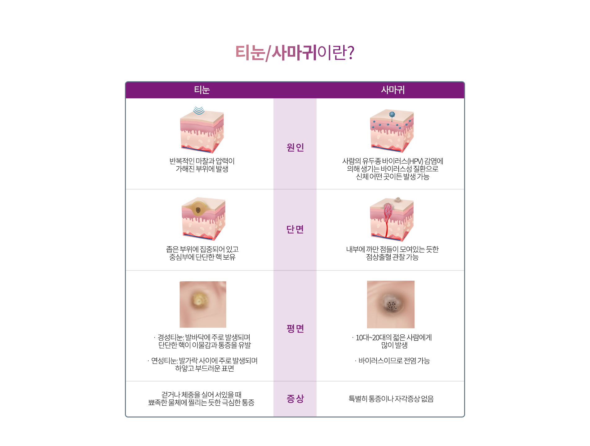 티눈/사마귀란?